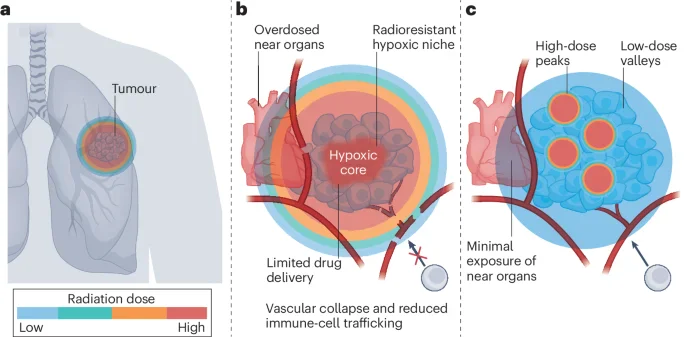 Spatial fractionated radiotherapy (SFRT) biedt alternatief voor homogene bestraling bij complexe tumoren