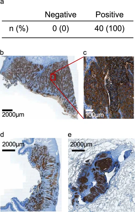 Sterke TROP2-expressie ondersteunt doelwitfunctie voor ADC-therapie bij slokdarmkanker